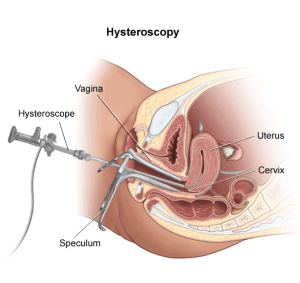 Hysteroscopy