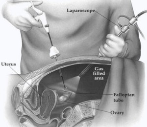 Laparoscopic Gynaecological Procedures