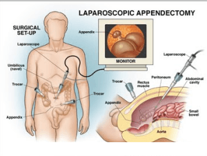 Laparoscopic appendectomy