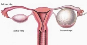 Ovarian Cysts