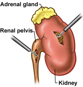 Pyelolithotomy