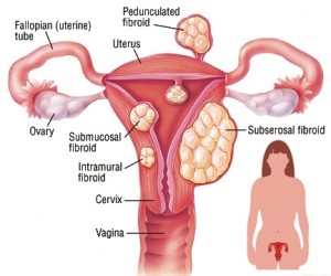 Laparoscopic fibroid Surgery in india