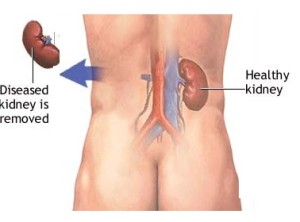 kidney removal