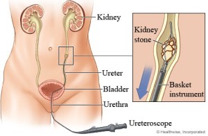 kidney stone