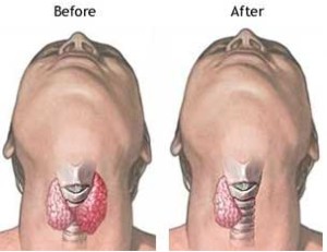 thyroidectomy