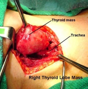 thyroidectomy