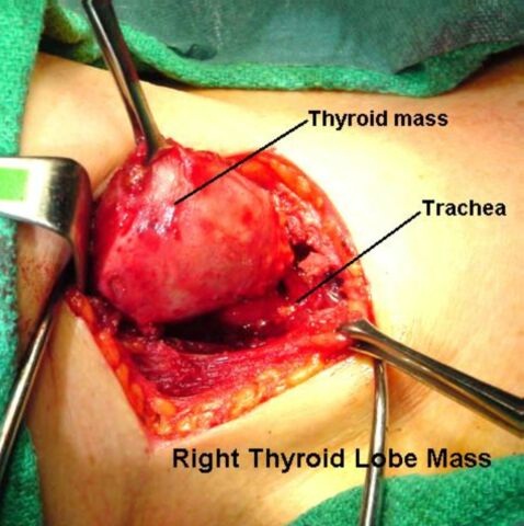 thyroidectomy parathyroidectomy