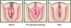 Labiaplasty & vaginoplasty