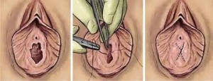 hymenoplasty